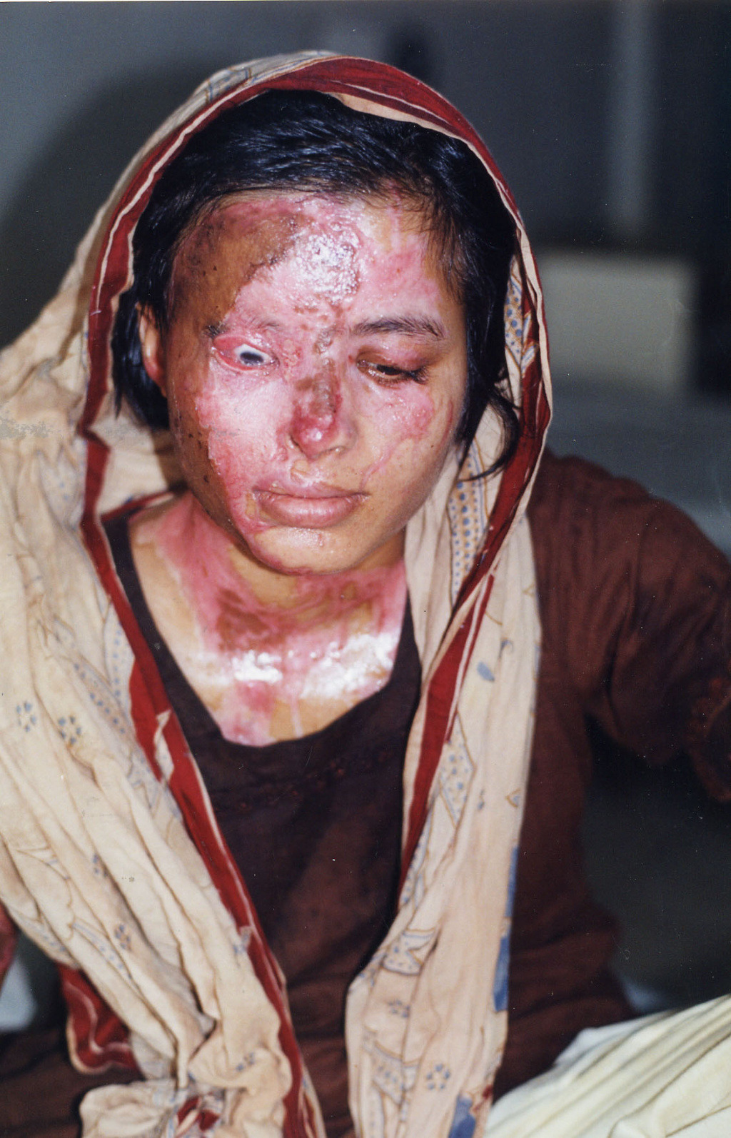 남자의 청혼/성관계를 거부했다는 이유로 염산테러를 당한 파키스탄 여성들....ㅠㅠ | 인스티즈