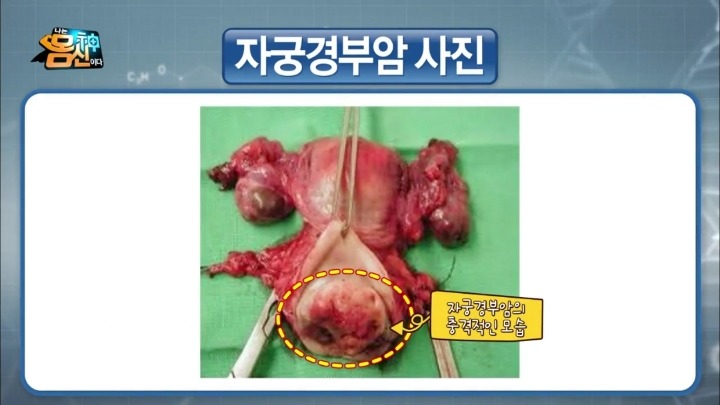 자궁경부암 실제사진.jpg (사진주의) | 인스티즈