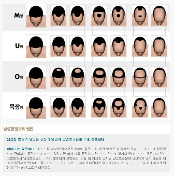 탈모의 유형.JPG | 인스티즈