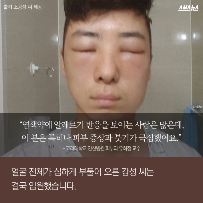 염색약 바르는데 피부가 부어오른 이유 | 인스티즈