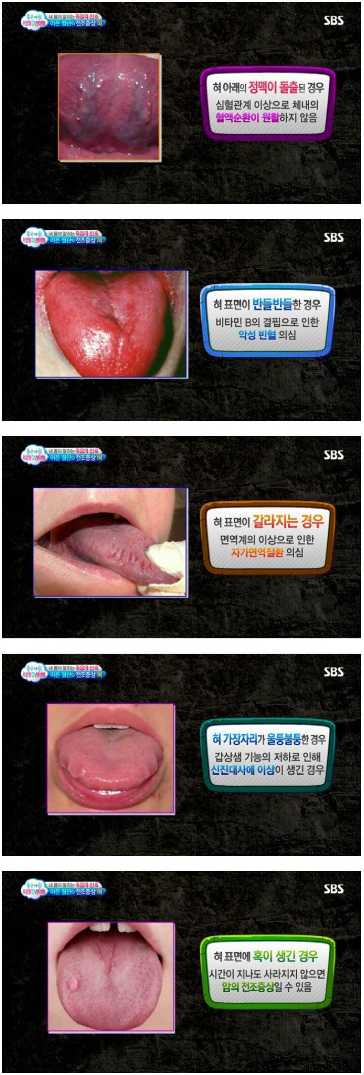 자신의 혀 상태를 알아보도록 하자.(약혐 | 인스티즈